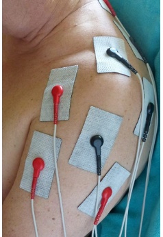 Patient mit Schmerzen im Bereich der linken Schulter und zugehörige Platzierung der Mikrostrom-Elektroden